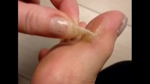 Playing with Thick Yellow Callus on my Bigtoe